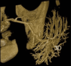 דוגמא לבדיקת Sialo CBCT – בה מודגמת מערכת צינורות נורמאלית של בלוטת הרוק הפרוטיד