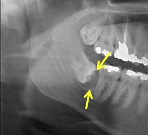 תמונה 1 תצלום פנורמי המדגים Dentigerous cyst סביב כותרת של שן בינה כלואה
